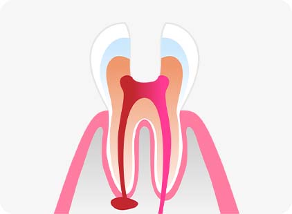 충치로 감염된 치아의 법랑질과 상아질을 정교하게 제거하여 신경치료를 위한 기초를 다지는 부산 영도 편한치과 과정